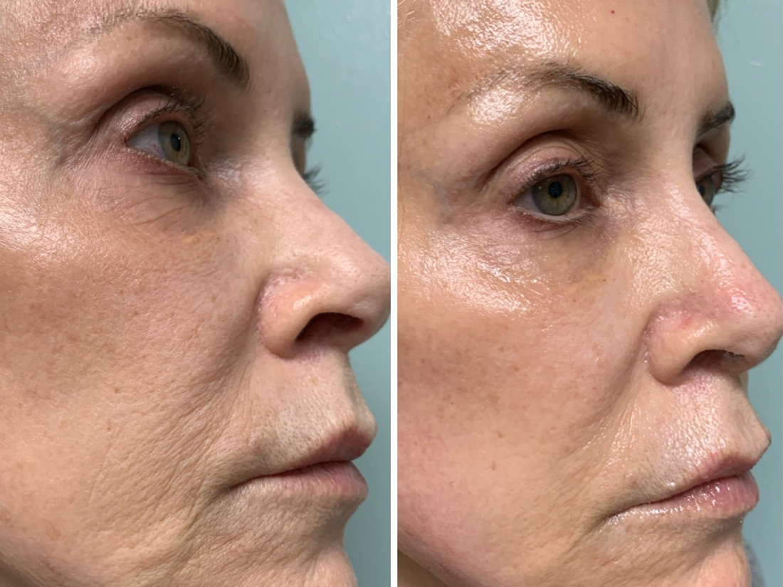 Diminish the Appearance of Wrinkles for a Youthful Look.