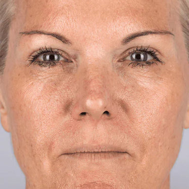 Wrinkles before